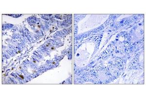 Immunohistochemistry analysis of paraffin-embedded human colon carcinoma tissue using Nuclear Receptor NR4A1 (Phospho-Ser351) antibody. (NR4A1 anticorps  (pSer351))