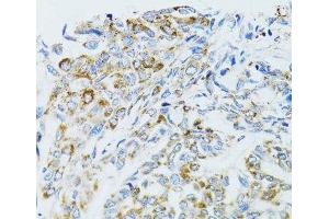 Immunohistochemistry of paraffin-embedded Human liver cancer using EGFR Polyclonal Antibody at dilution of 1:100 (40x lens). (EGFR anticorps)