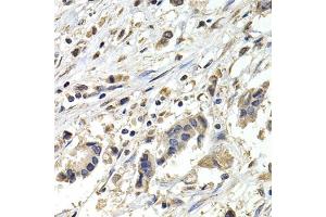 Immunohistochemistry of paraffin-embedded human breast cancer using BUB1B antibody (ABIN5970893) at dilution of 1/200 (40x lens). (BUB1B anticorps)