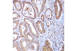 Immunohistochemical analysis of MRPL24 staining in human colon cancer formalin fixed paraffin embedded tissue section. (MRPL24 anticorps  (Center))