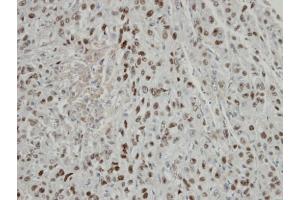IHC-P Image Immunohistochemical analysis of paraffin-embedded Mahlavu xenograft, using COPS2, antibody at 1:100 dilution. (COPS2 anticorps  (C-Term))