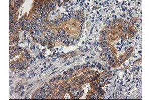 Immunohistochemical staining of paraffin-embedded Adenocarcinoma of Human colon tissue using anti-BCAR1 mouse monoclonal antibody. (BCAR1 anticorps)