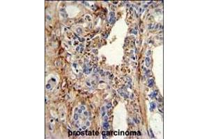 Immunohistochemistry (Paraffin-embedded Sections) (IHC (p)) image for anti-Cyclin-Dependent Kinase 4 (CDK4) (AA 273-305), (C-Term) antibody (ABIN391751)