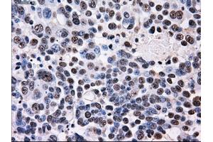 Immunohistochemical staining of paraffin-embedded Adenocarcinoma of colon tissue using anti-ID3mouse monoclonal antibody. (ID3 anticorps)