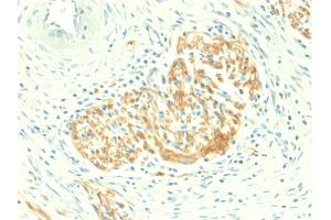 Formalin-fixed, paraffin-embedded human Colon Carcinoma stained with CD56 Rabbit Recombinant Monoclonal Antibody (NCAM1/2217R). (Recombinant CD56 anticorps)