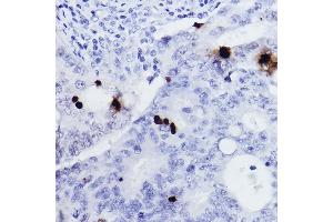 Immunohistochemistry of paraffin-embedded human colon carcinoma using Phospho-Histone H3-S10 Rabbit pAb (ABIN7267687) at dilution of 1:2000 (40x lens). (Histone 3 anticorps  (H3S10p))