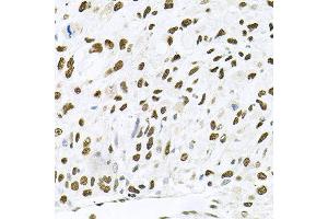 Immunohistochemistry of paraffin-embedded human lung cancer using MAPK8 antibody at dilution of 1:100 (x40 lens). (JNK anticorps)
