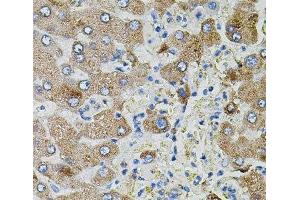 Immunohistochemistry of paraffin-embedded Human liver damage using TGFA Polyclonal Antibody (TGFA anticorps)