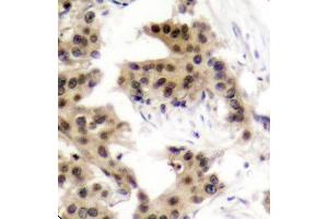 Immunohistochemistry of paraffin-embedded human breast carcinoma using Phospho-NFKB1-S893 antibody (ABIN2988205). (NFKB1 anticorps  (pSer893))