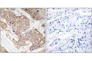 Immunohistochemistry analysis of paraffin-embedded human breast carcinoma tissue, using IL-13R/CD213 alpha1 (Ab-405) Antibody. (CD213alpha1 (AA 371-420) anticorps)