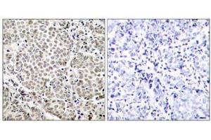 Immunohistochemical analysis of paraffin-embedded human breast carcinoma tissue, using NF-κB p65 (Phospho-Ser529) antibody (E011217). (NF-kB p65 anticorps  (pSer529))