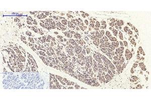 Immunohistochemistry of paraffin-embedded Human stomach cancer tissue with Phospho-FAK (Tyr397) Polyclonal Antibody at dilution of 1:200 (FAK anticorps  (pTyr397))