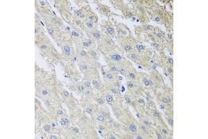 Immunohistochemistry of paraffin-embedded human liver cancer using MLKL antibody at dilution of 1:100 (40x lens). (MLKL anticorps)