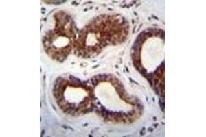Immunohistochemistry analysis in formalin fixed and paraffin embedded human breast tissue recated with KIAA1586 Antibody (N-term) followed by peroxidase conjugation of the secondary antibody and DAB staining. (KIAA1586 anticorps  (N-Term))