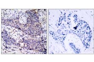 Immunohistochemical analysis of paraffin-embedded human breast carcinoma tissue using BAD (Ab-136) antibody (E021063). (BAD anticorps)