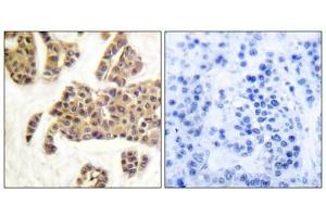 Immunohistochemical analysis of paraffin-embedded human breast carcinoma tissue using BAD (Phospho-Ser91/128) antibody (left)or the same antibody preincubated with blocking peptide (right). (BAD anticorps  (pSer91, pSer128))
