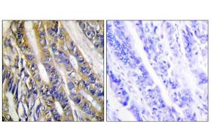 Immunohistochemistry analysis of paraffin-embedded human colon carcinoma tissue, using DGKH antibody. (DGKH anticorps  (Internal Region))