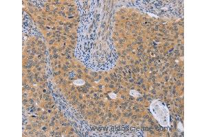 Immunohistochemistry of Human cervical cancer using BRS3 Polyclonal Antibody at dilution of 1:50 (BRS3 anticorps)
