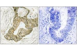 Immunohistochemistry analysis of paraffin-embedded human breast carcinoma tissue, using p90 RSK (Ab-380) Antibody. (RPS6KA3 anticorps  (AA 346-395))