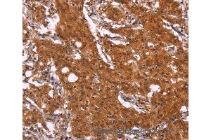 Immunohistochemistry of Human gastric cancer using APMAP Polyclonal Antibody at dilution of 1:30 (APMAP anticorps)