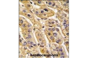 Formalin-fixed and paraffin-embedded human hepatocarcinoma tissue reacted with HIBCH antibody (Center), which was peroxidase-conjugated to the secondary antibody, followed by DAB staining. (HIBCH anticorps  (AA 183-209))