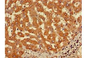 Immunohistochemistry of paraffin-embedded human liver cancer using ABIN7149214 at dilution of 1:100 (Cytochrome P450, Family 2, Subfamily A, Polypeptide 1 (CYP2A1) (AA 91-390) anticorps)