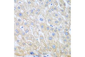 Immunohistochemistry of paraffin-embedded human liver cancer using PTGS1 antibody at dilution of 1:100 (40x lens). (PTGS1 anticorps)