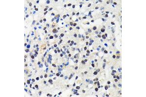 Immunohistochemistry of paraffin-embedded human oophoroma using Cullin 3 antibody (ABIN7266543) at dilution of 1:100 (40x lens). (Cullin 3 anticorps)