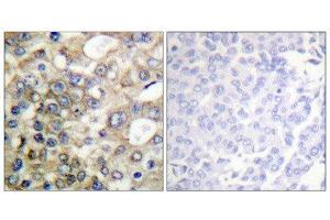 Immunohistochemistry (IHC) image for anti-Mucin 1 (MUC1) (pTyr1229) antibody (ABIN1847433) (MUC1 anticorps  (pTyr1229))