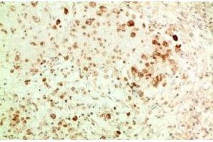 Immunohistochemistry of paraffin-embedded Human ovarian carcinoma tissue using ATG5 Monoclonal Antibody at dilution of 1:200. (ATG5 anticorps)