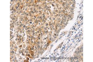 Immunohistochemistry of Human lung cancer using MAPK9 Polyclonal Antibody at dilution of 1:30 (JNK2 anticorps)