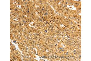 Immunohistochemistry of Human ovarian cancer using AKR1A1 Polyclonal Antibody at dilution of 1:25 (AKR1A1 anticorps)