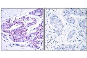 Immunohistochemical analysis of paraffin- embedded human breast carcinoma tissue using NF-κB p65 (Ab-468) antibody (E021013). (NF-kB p65 anticorps)