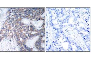 Immunohistochemical analysis of paraffin-embedded human breast carcinoma tissue, using MEK1 (phospho-Ser217) antibody (E011205). (MEK1 anticorps  (pSer217))