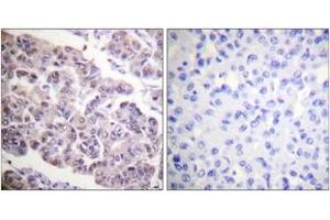 Immunohistochemistry analysis of paraffin-embedded human breast carcinoma tissue, using Histone H4 (Acetyl-Lys12) Antibody. (Histone H4 anticorps  (acLys12))