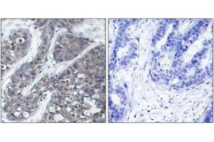 Immunohistochemistry analysis of paraffin-embedded human breast carcinoma tissue, using PYK2 (Ab-402) Antibody. (PTK2B anticorps  (AA 369-418))