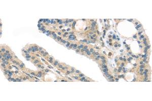 Immunohistochemistry of paraffin-embedded Human thyroid cancer using VPS26A Polyclonal Antibody at dilution of 1/40 (VPS26A anticorps)