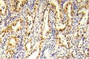 Immunohistochemistry (IHC) analyzes of p-Tsc2 antibody in paraffin-embedded human prostate carcinoma tissue. (Tuberin anticorps  (pSer1254))
