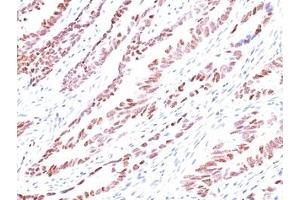 Formalin-fixed, paraffin-embedded human colon carcinoma stained with p57 antibody (KP10). (P57 anticorps)