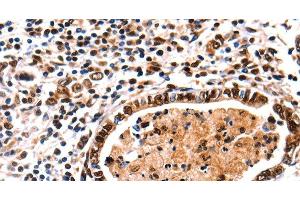 Immunohistochemistry of paraffin-embedded Human stomach cancer tissue using DNMT3A Polyclonal Antibody at dilution 1:65 (DNMT3A anticorps)