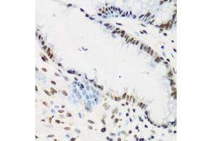 Immunohistochemistry of paraffin-embedded human stomach cancer using KLF4 antibody. (KLF4 anticorps)
