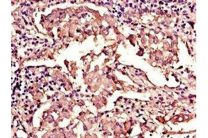 Immunohistochemistry of paraffin-embedded human lung cancer using ABIN7157854 at dilution of 1:100 (Lamin B1 anticorps  (AA 385-552))