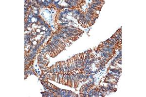 Immunohistochemistry of paraffin-embedded human colon carcinoma using GP Rabbit mAb (ABIN1682863, ABIN3017875, ABIN3017876 and ABIN7101532) at dilution of 1:100 (40x lens). (GPA33 anticorps)