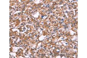 Immunohistochemistry of Human gastric cancer using GPC6 Polyclonal Antibody at dilution of 1:40 (Glypican 6 anticorps)