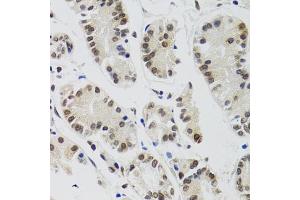 Immunohistochemistry of paraffin-embedded human gastric cancer using EDF1 antibody. (EDF1 anticorps)