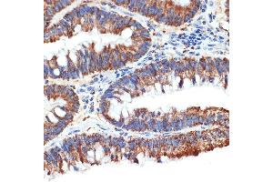 Immunohistochemistry of paraffin-embedded human colon carcinoma using P Rabbit mAb (ABIN1682842, ABIN3019312, ABIN3019313 and ABIN7101749) at dilution of 1:100 (40x lens). (PAWR anticorps)