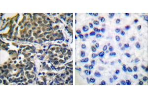 Peptide - +Immunohistochemical analysis of paraffin-embedded human breast carcinoma tissue using HSP90B (Ab-254) antibody (#B0013). (HSP90AB1 anticorps  (Ser254))