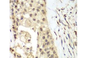Immunohistochemistry of paraffin-embedded Human lung cancer using FGFR1 Polyclonal Antibody at dilution of 1:100 (40x lens). (FGFR1 anticorps)