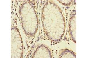 Immunohistochemistry of paraffin-embedded human colon cancer using ABIN7166047 at dilution of 1:100 (S1A14 (AA 1-104) anticorps)