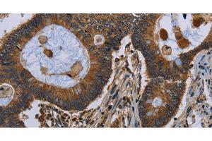 Immunohistochemistry of paraffin-embedded Human colon cancer tissue using FGF18 Polyclonal Antibody at dilution 1:40 (FGF18 anticorps)